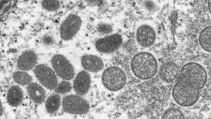 Should I Be Worried About Monkeypox? - Vimarsana News