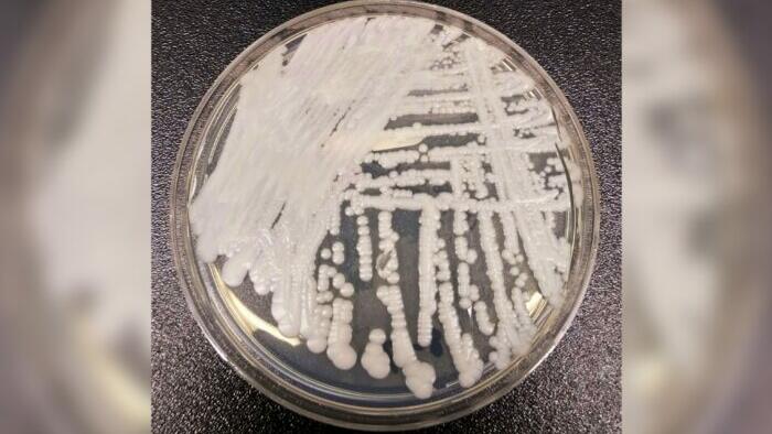 NextImg:CDC Warns Of Dangerous Fungal Infection Spreading Through US At 'Alarming Rate'