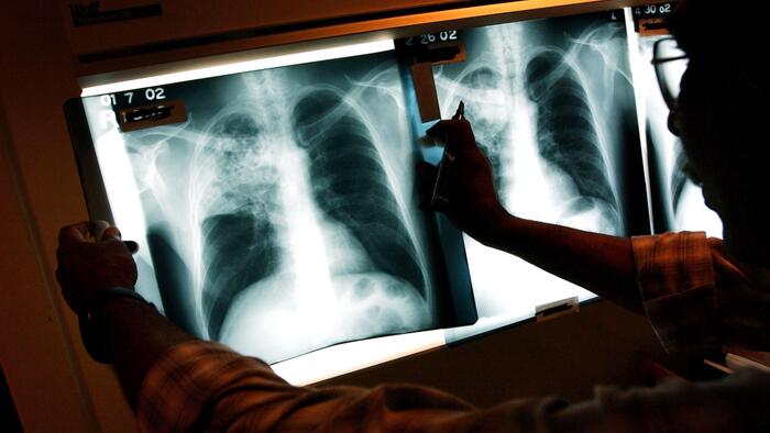 NextImg:Illegal Immigrant Children With Tuberculosis Released Across US