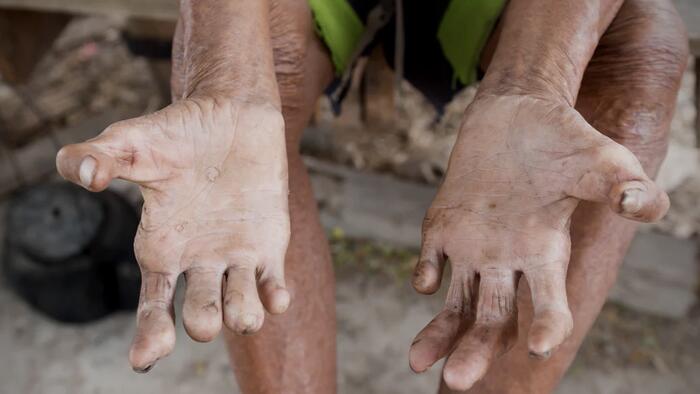 NextImg:Central Florida: Leprosy Capital Of The USA