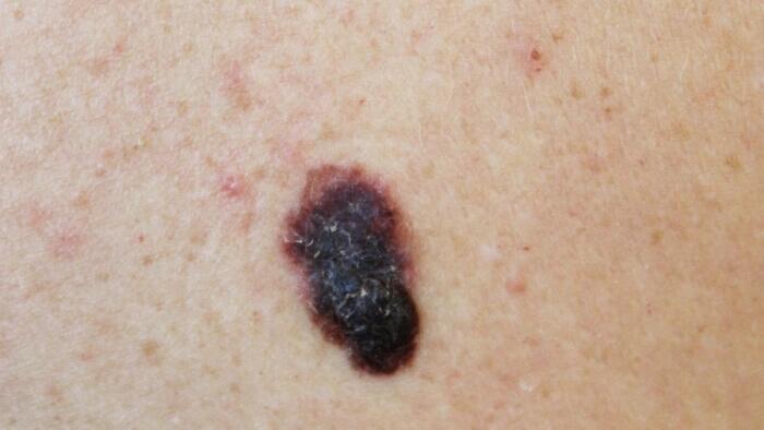 NextImg:FDA Approves 1st T-Cell Therapy For Melanoma
