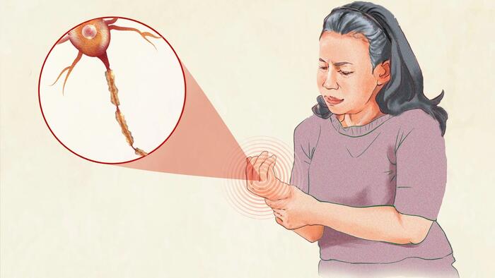 NextImg:Peripheral Neuropathy: Symptoms, Causes, Treatments, And Natural Approaches