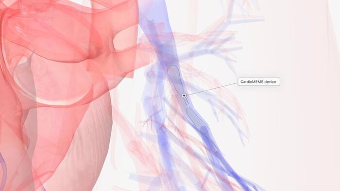 NextImg:A Paper Clip-Sized Device Is Changing Heart Failure Treatment