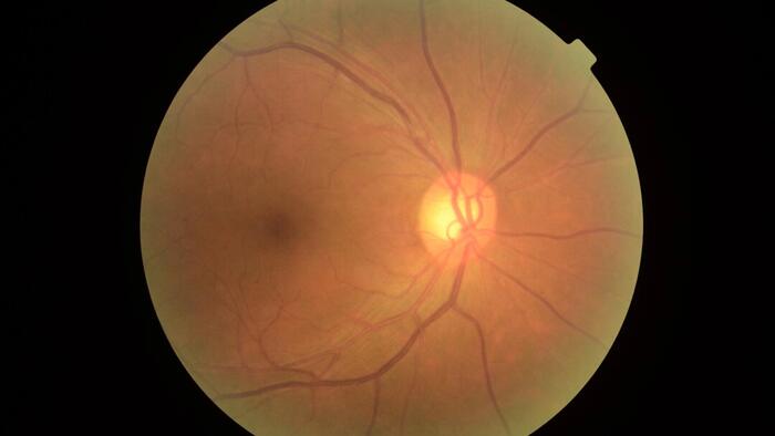 NextImg:Scientists Identify New Protein That Drives Age-Related Blindness, Uncover Potential Therapy