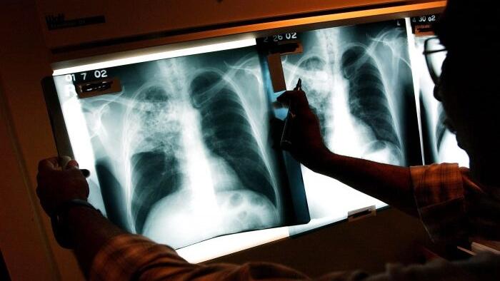 NextImg:WHO: Global Tuberculosis Cases Hit Highest Number Since Monitoring Began In 1995