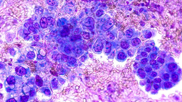 NextImg:Sugar Stores In The Body May Fuel Common Lung Cancer Progression: Study