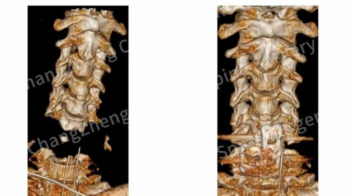 NextImg:Robot Nearly Decapitates Man In Gruesome Surgery Fail