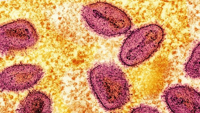 Severe Mpox Virus Strain Possibly Spreading In LA County, Officials Warn Severe Mpox Virus Strain Possibly Spreading In LA County, Officials Warn