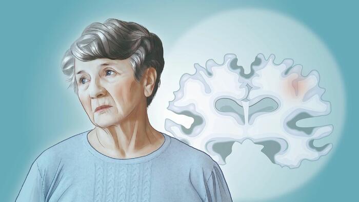 Alzheimer’s Disease: The Most Common Neurodegenerative Disease – Here Are The Causes Alzheimer’s Disease: The Most Common Neurodegenerative Disease – Here Are The Causes