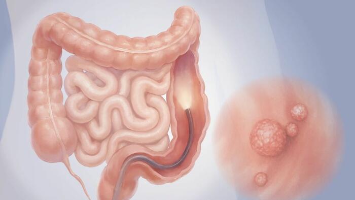 Colonoscopy: The Most Used Screening Test For Colon Cancer, Here Are The Benefits And Risks