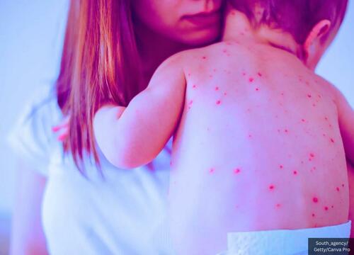 Texas Gave 15,000 More MMR Shots This Year – Now It Has More Measles Cases Than the Entire US Had In 2024