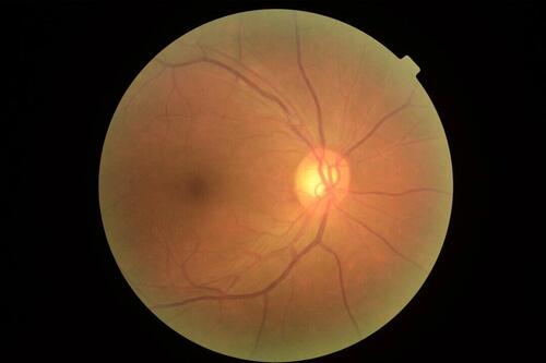 Scientists Identify New Protein That Drives Age-Related Blindness, Uncover Potential Therapy