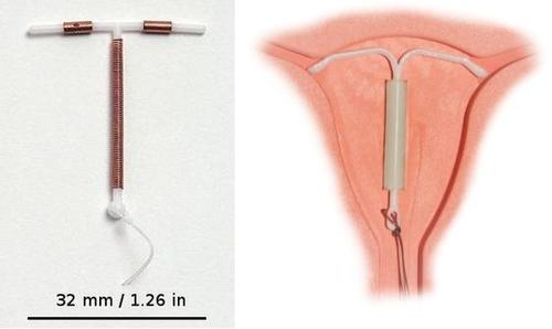IUDs are either copper-wrapped (left) or release birth control hormones