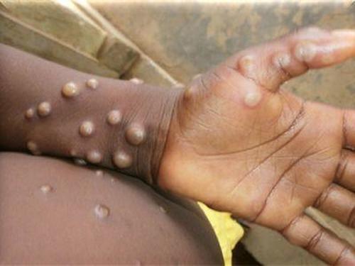CDC Scrambles After Rare Case Of Monkeypox Turns Up In Texas | The