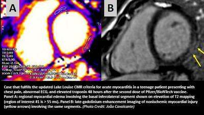 Main news thread - conflicts, terrorism, crisis from around the globe - Page 32 MyocarditismRNAvaccine%20text